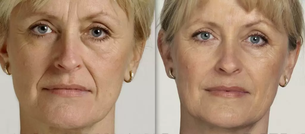 botox vs dermal fillers