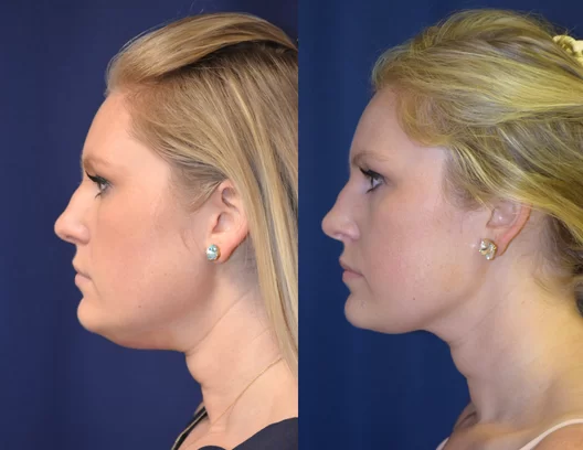 how to reduce double chin