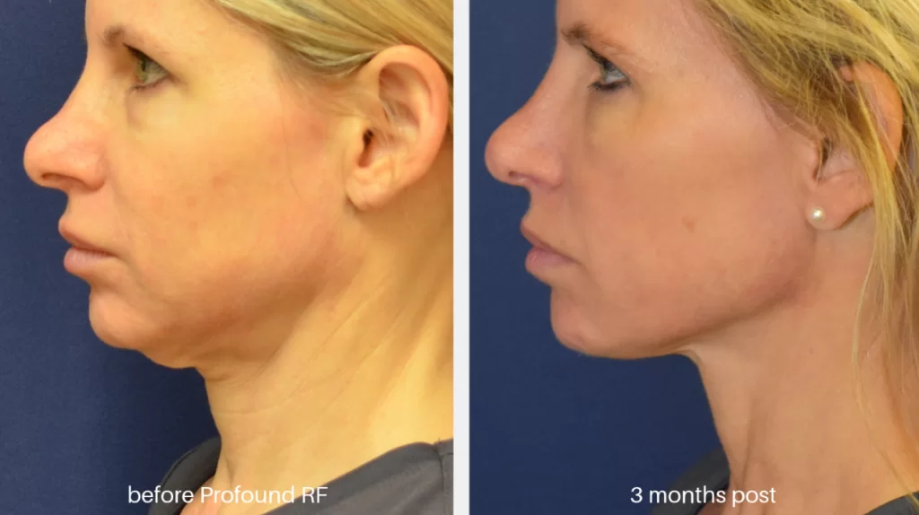non-surgical facelift options
