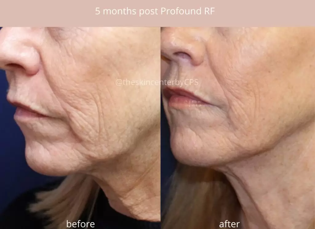 profound laser before and after