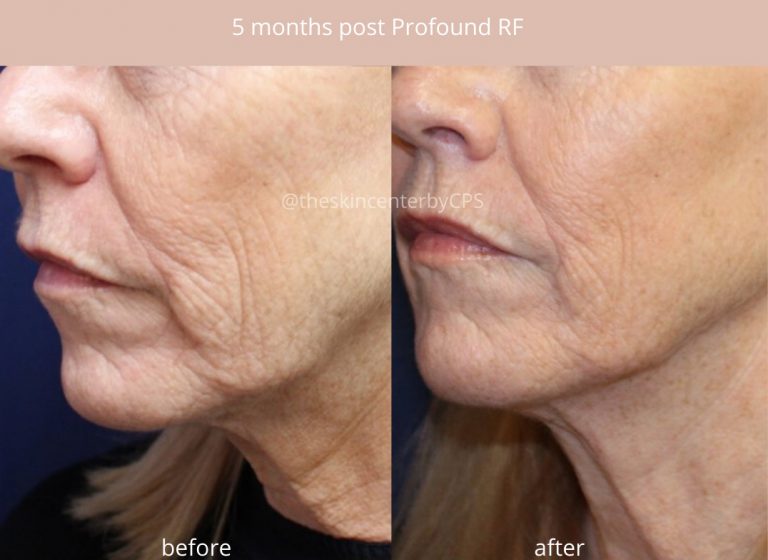 Profound treatment Skin Tightening Treatment