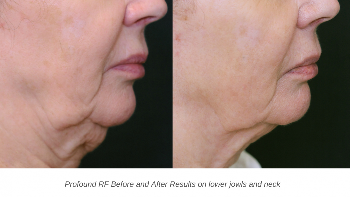 Profound treatment Skin Tightening Treatment