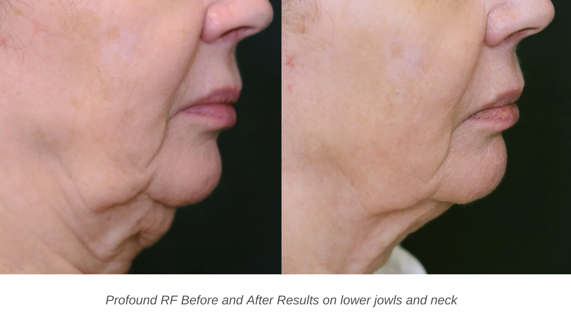profound laser before and after at the skin center