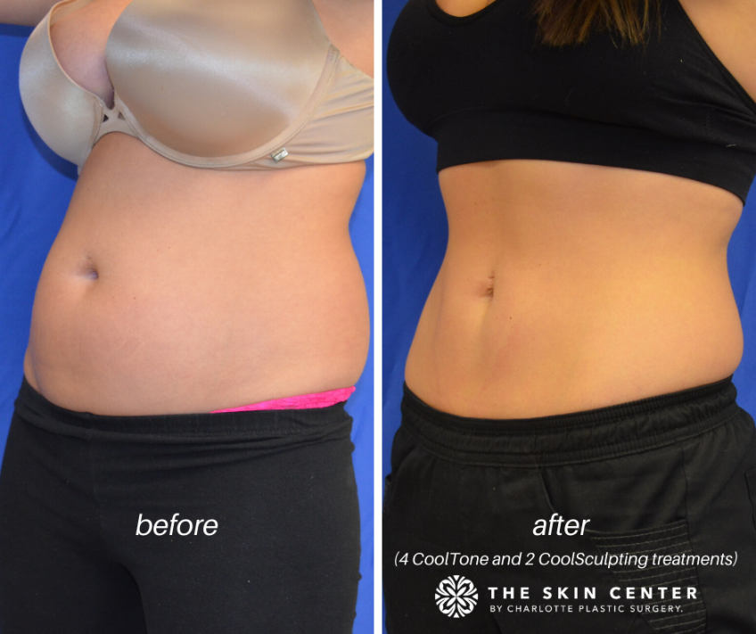 CoolTone™ vs CoolSculpting® Working Together