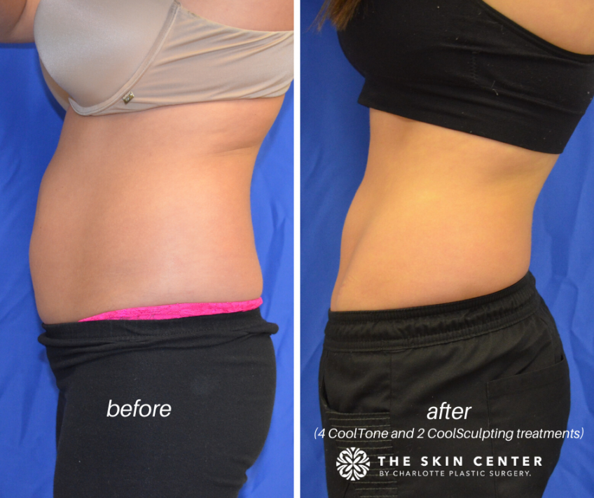CoolTone™ vs CoolSculpting® Working Together