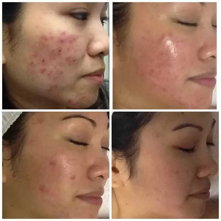 diamondglow facial before and after photos