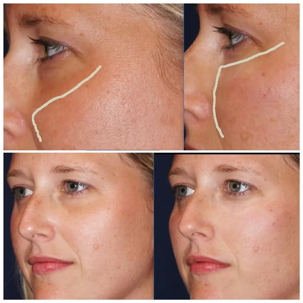 dermal filler