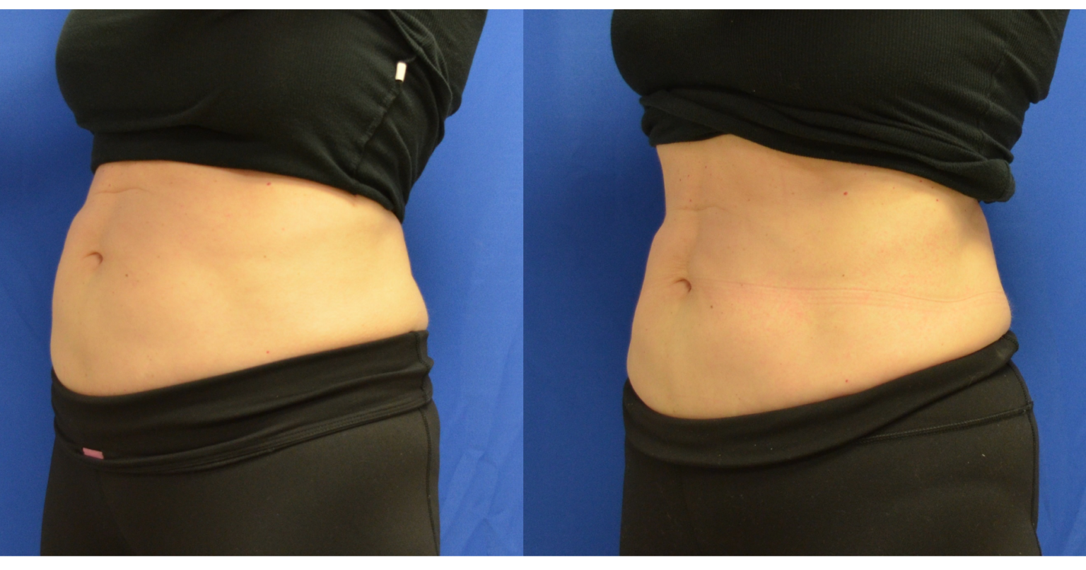 Real Patient Review CoolTone Body Contouring Treatment