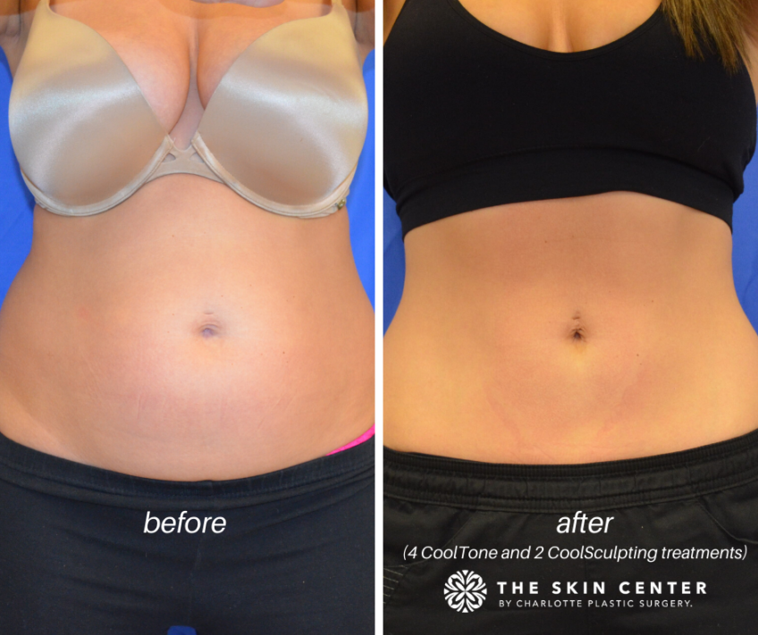 What to Expect After CoolSculpting and CoolTone Body Contouring