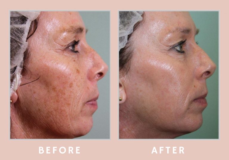 Is Sun Damage Reversible? Top Tips on How to Repair Sun Damaged Skin