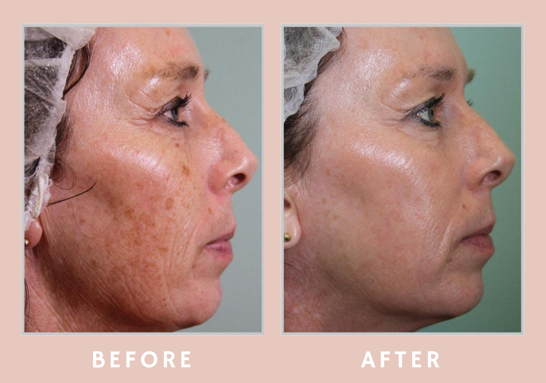 Is Sun Damage Reversible? Top Tips on How to Repair Sun Damaged Skin