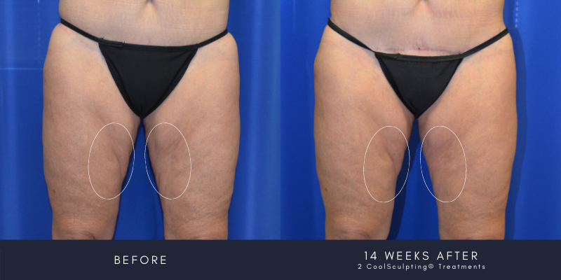 CoolSculpting Thighs
