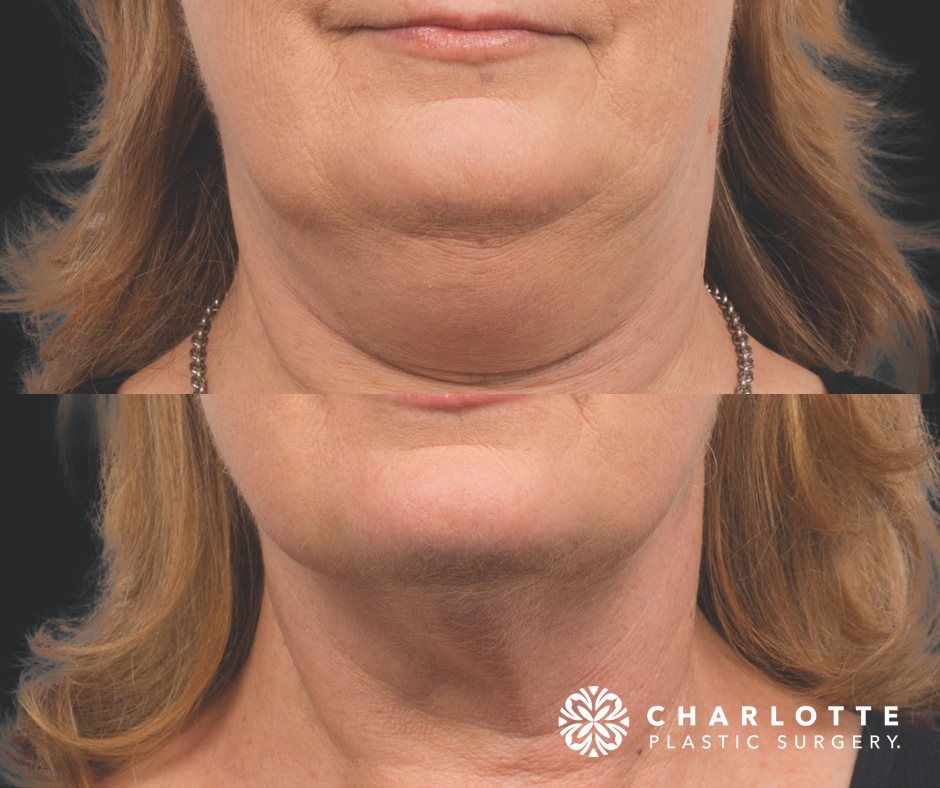 Looking to Bust that Double Chin? Learn About CoolSculpting vs Kybella