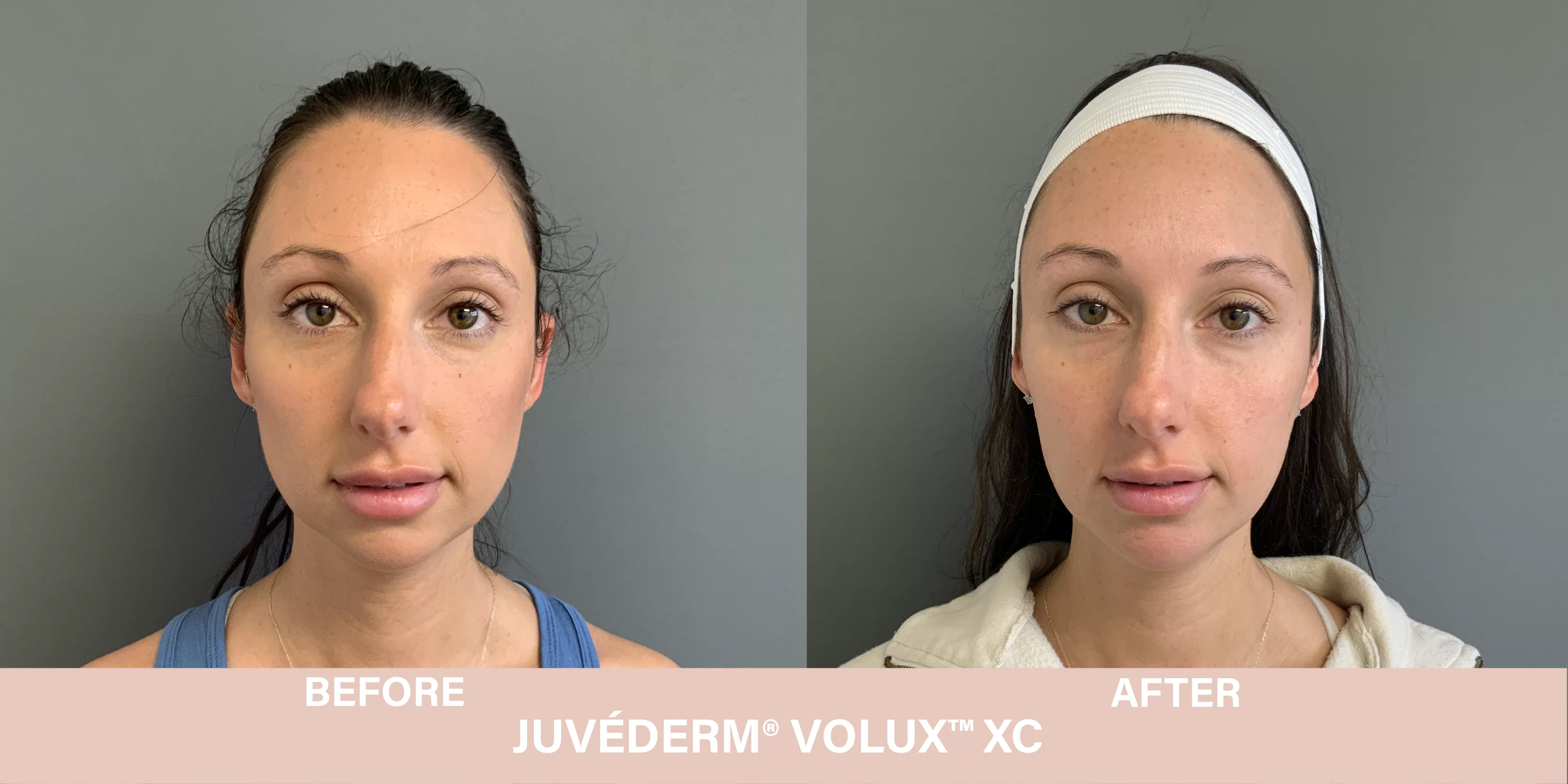 volux before and after