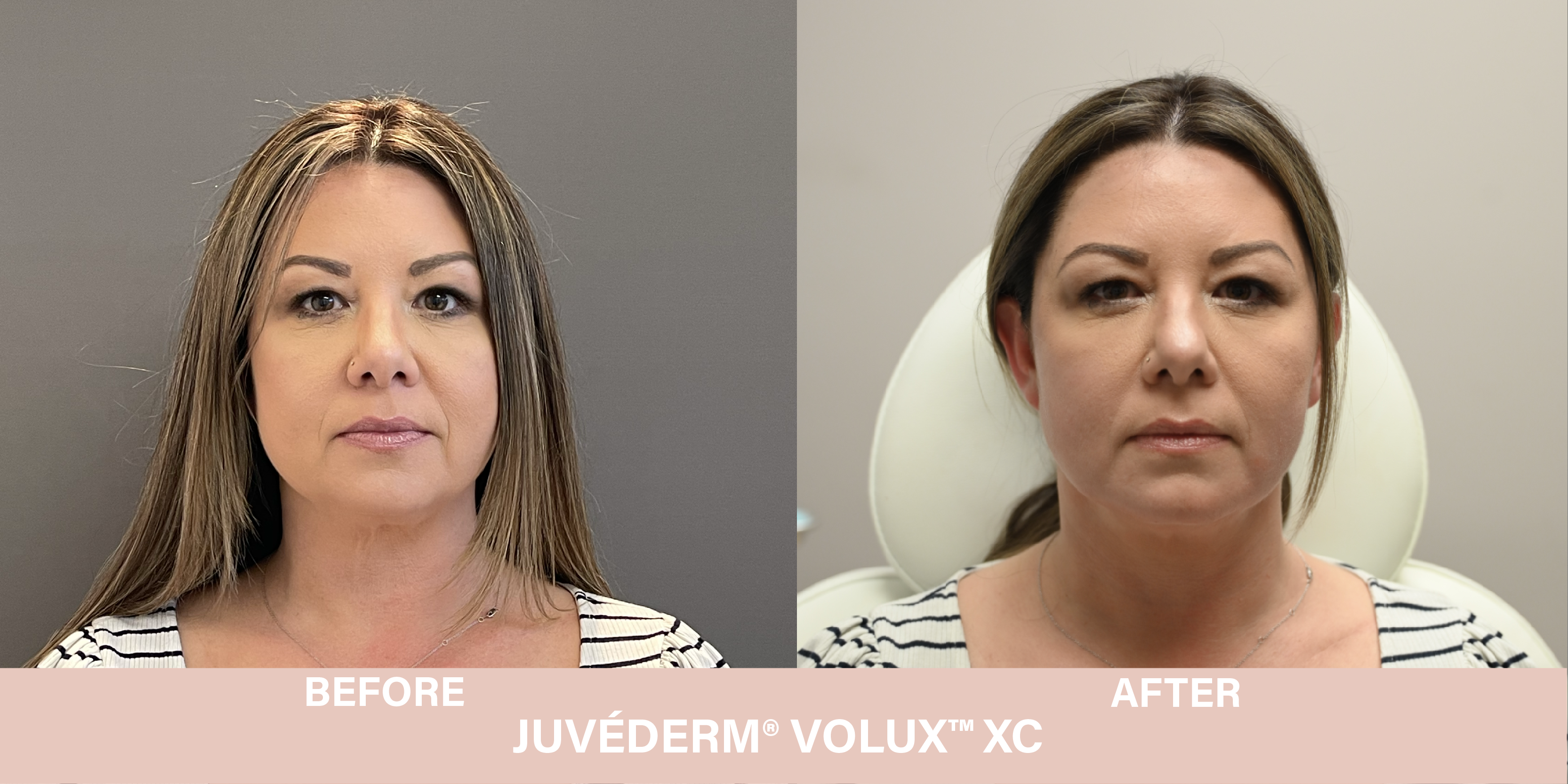 volux before and after