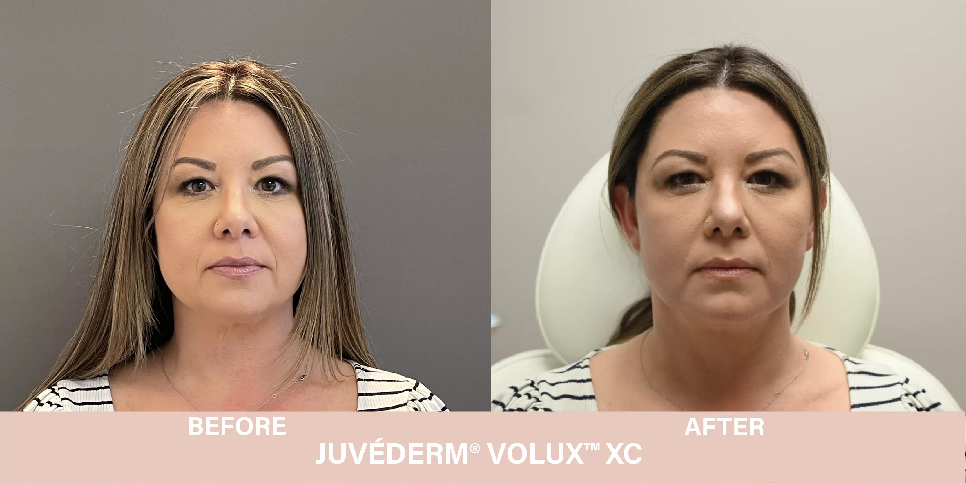 volux-before-after-2 volux before and after