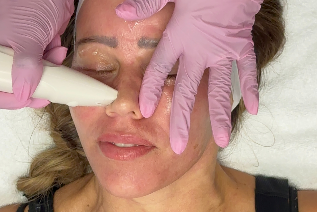 vivace vs microneedling